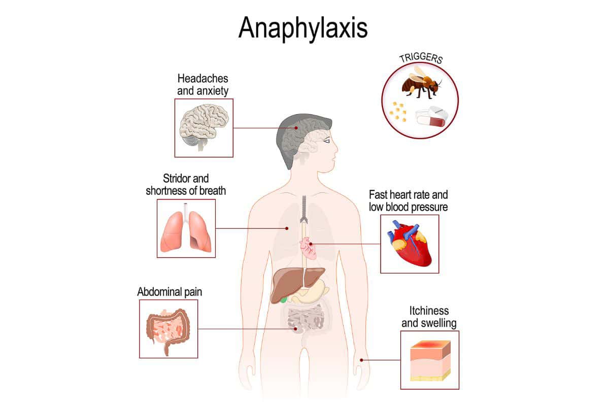 anaphalaxis diagram.